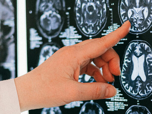 Fingers pointing at x-ray of skull